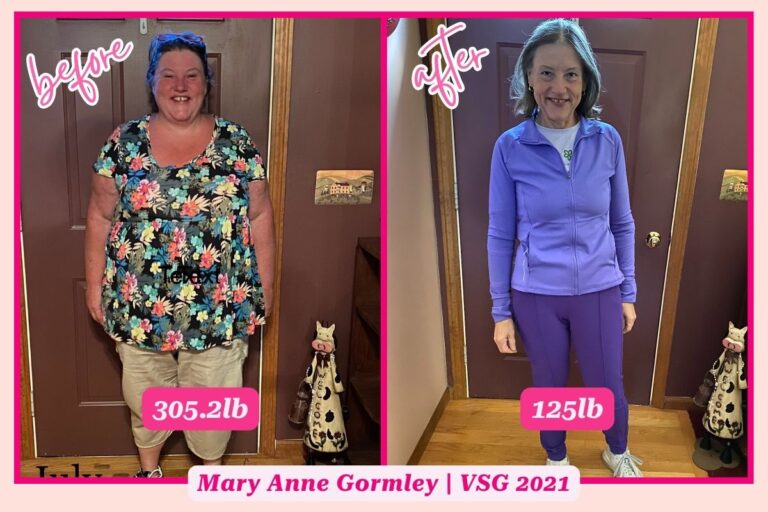 Gastric Sleeve Before and After (20+ Photos!) - The Sleeved Dietitian ...