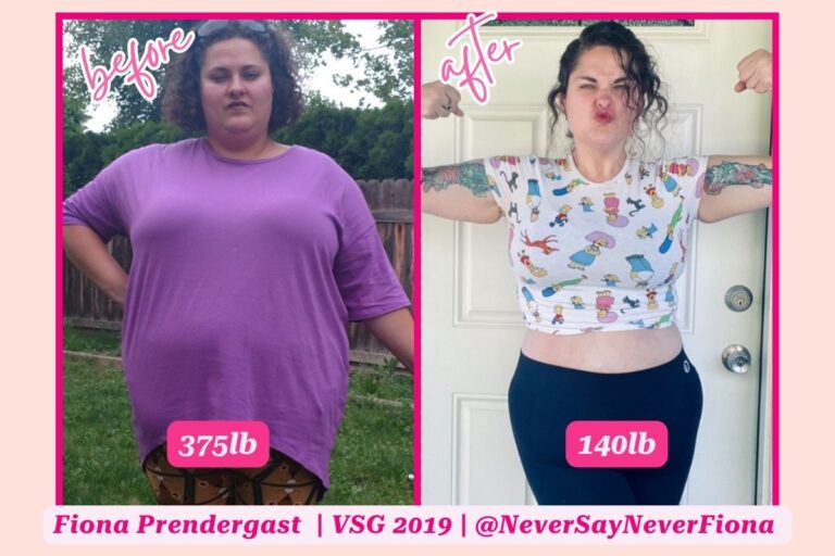 Gastric Sleeve Before and After (20+ Photos!) - The Sleeved Dietitian ...